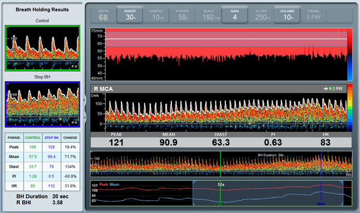 Breath Holding with Dolphin TCD Machine