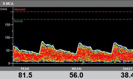 Using Automatic Thresholds with TCD for Vasospasm Detection