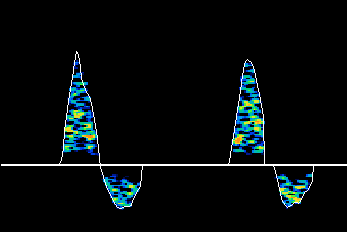 Example of Bi-phasic Doppler Waveform