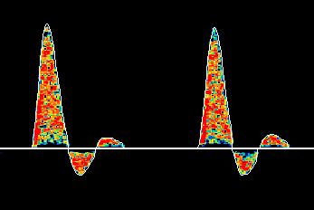 Example of a tri-phasic Doppler waveform