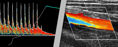 Peripheral Vascular Diagnostic Devices Complement Ultrasound Imaging