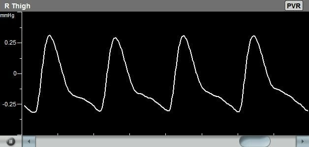 Example of a Pulse Volume Recording (PVR) Waveform