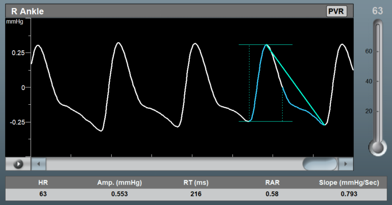 Pulse Volume Recording Waveform