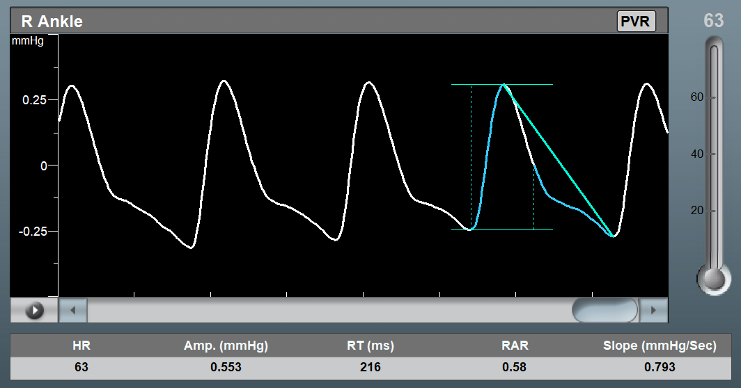 FAQ about Pulse Volume Recording (PVR)