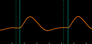 Pulse Wave Velocity Waveform