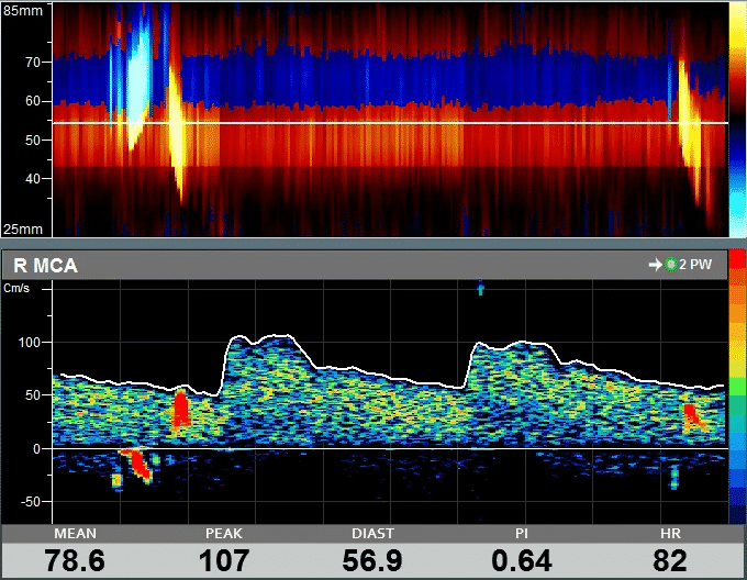 Example of Emboli Detected over Power M Mode and Spectral Display