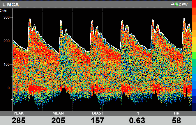 TCD Spectrum Showing Vasospasm