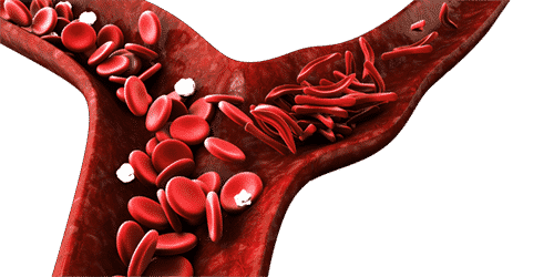 Sickle Cell Disease Test with TCD