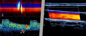 TCD vs. TCCD Color Doppler Ultrasound