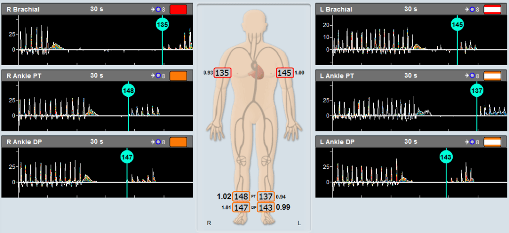 Example of an ABI Assessment using Doppler and pressure cuffs