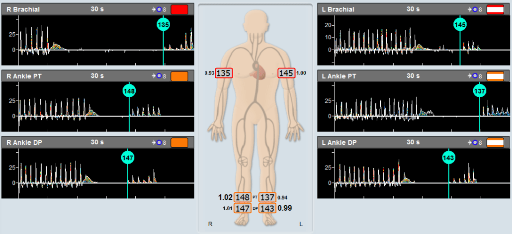 Segmental Blood Pressures for Vascular Diagnosis - Viasonix