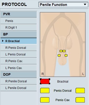 Thoracic Outlet Syndrome (TOS) Test - Viasonix